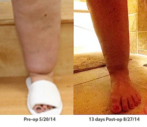 Lipedema Centers patient Vicki shows one of her legs just before her first surgery and two weeks post-op.